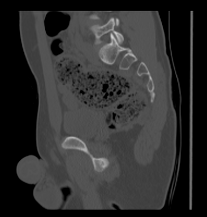 Aneurysmal bone cyst of ischium (Radiopaedia 25957-26094 Sagittal bone window 43).png