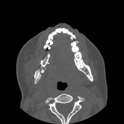 File:Aneurysmal bone cyst of the mandible (Radiopaedia 43280-46823 Axial bone window 60).jpg
