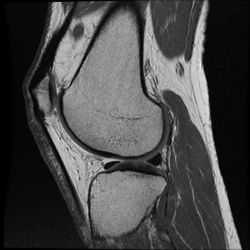 Anomalous insertion of the medial meniscus (Radiopaedia 77559-89721 Sagittal PD 19).jpg