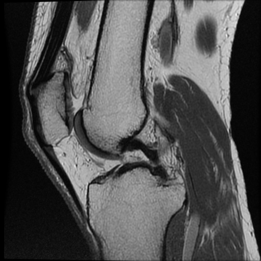 Anomalous insertion of the medial meniscus (Radiopaedia 77559-89721 Sagittal PD 30).jpg