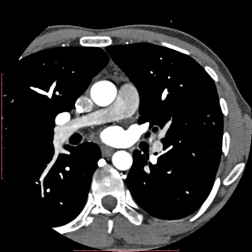File:Anomalous left coronary artery from the pulmonary artery (ALCAPA) (Radiopaedia 70148-80181 A 25).jpg