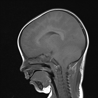 File:Anoxic brain injury (Radiopaedia 79165-92139 Sagittal T1 10).jpg