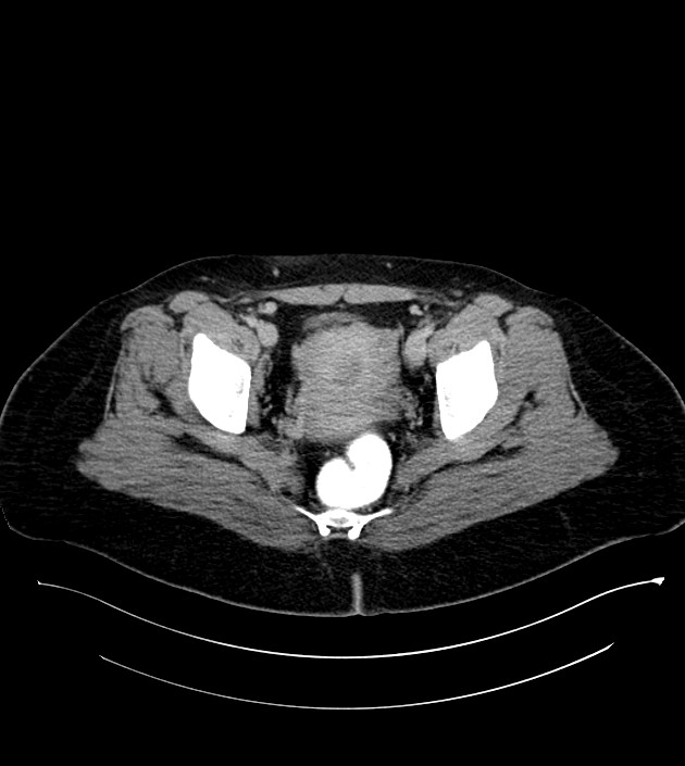 Anterior abdominal wall CSF pseudocyst (CSFoma) (Radiopaedia 79453-92571 A 82).jpg