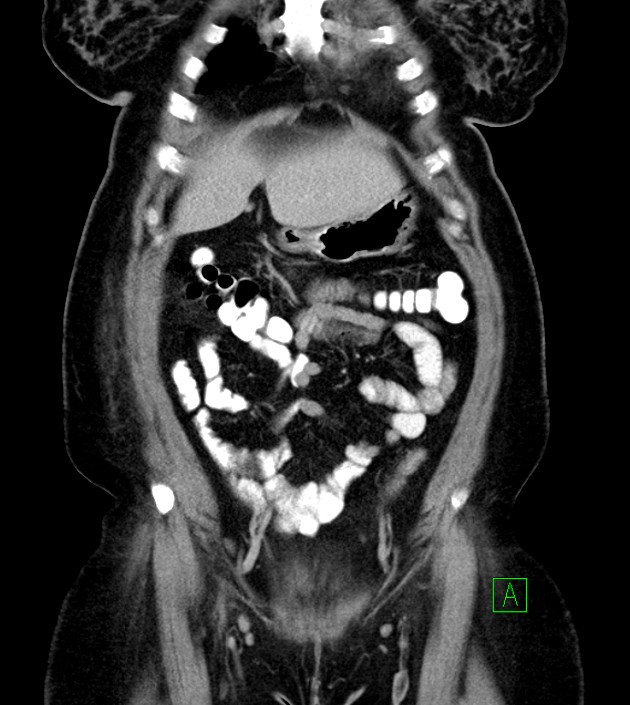 Anterior abdominal wall CSF pseudocyst (CSFoma) (Radiopaedia 79453-92571 B 18).jpg