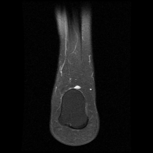 File:Anterior calcaneal process fracture (Radiopaedia 71377-81705 Coronal PD fat sat 16).jpg