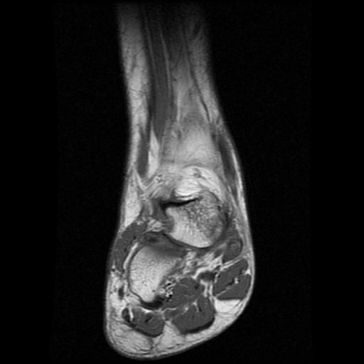 File:Anterior calcaneal process fracture (Radiopaedia 71377-81705 Coronal T1 4).jpg