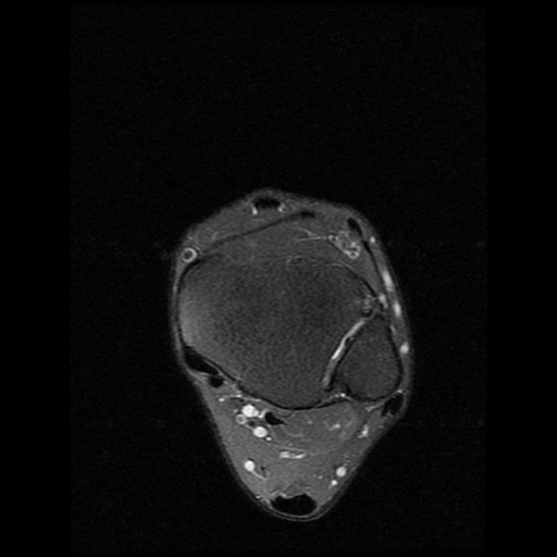 File:Anterior calcaneal process fracture (Radiopaedia 74654-85611 Axial PD fat sat 3).jpg