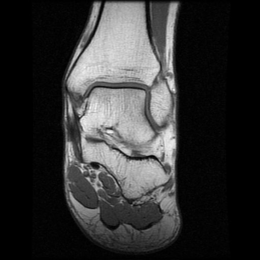 File:Anterior calcaneal process fracture (Radiopaedia 74654-85611 Coronal T1 11).jpg
