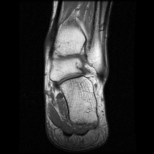 File:Anterior calcaneal process fracture (Radiopaedia 74654-85611 Coronal T1 17).jpg