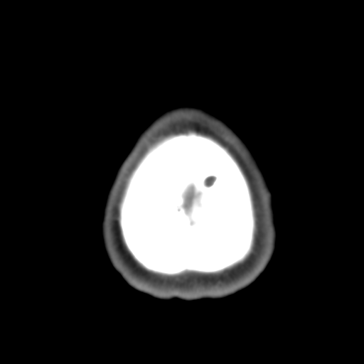 Anterior cerebral artery territory infarct (Radiopaedia 39327-41581 B 7).png
