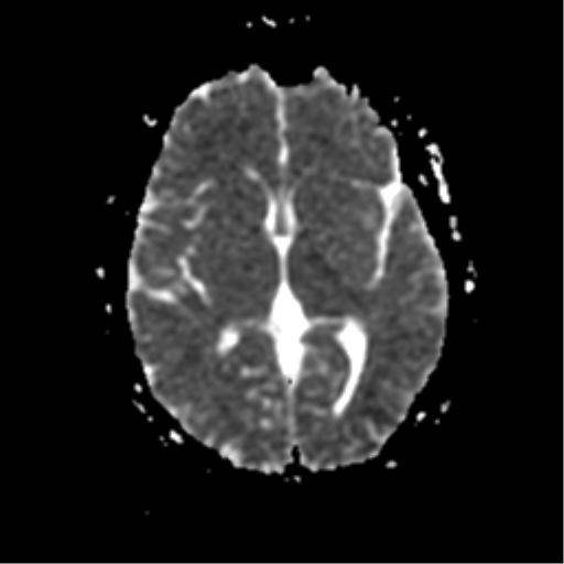 File:Anterior cerebral artery territory infarct (Radiopaedia 39327-41584 Axial ADC 13).png