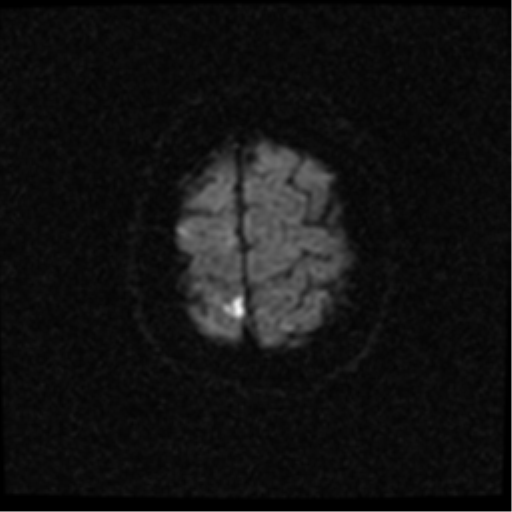 File:Anterior cerebral artery territory infarct (Radiopaedia 39327-41584 Axial DWI 24).png