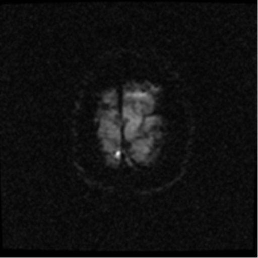 File:Anterior cerebral artery territory infarct (Radiopaedia 39327-41584 Axial DWI 25).png