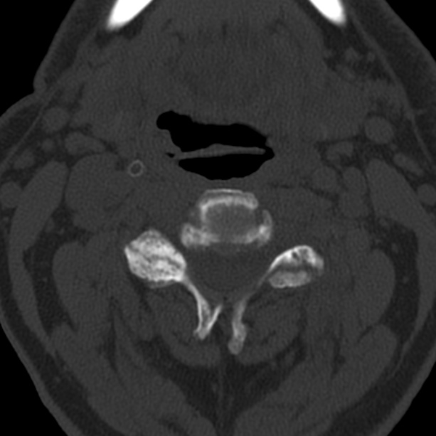 Anterior cervical postdiscectomy arthrodesis (Radiopaedia 32678-33646 Axial bone window 31).jpg