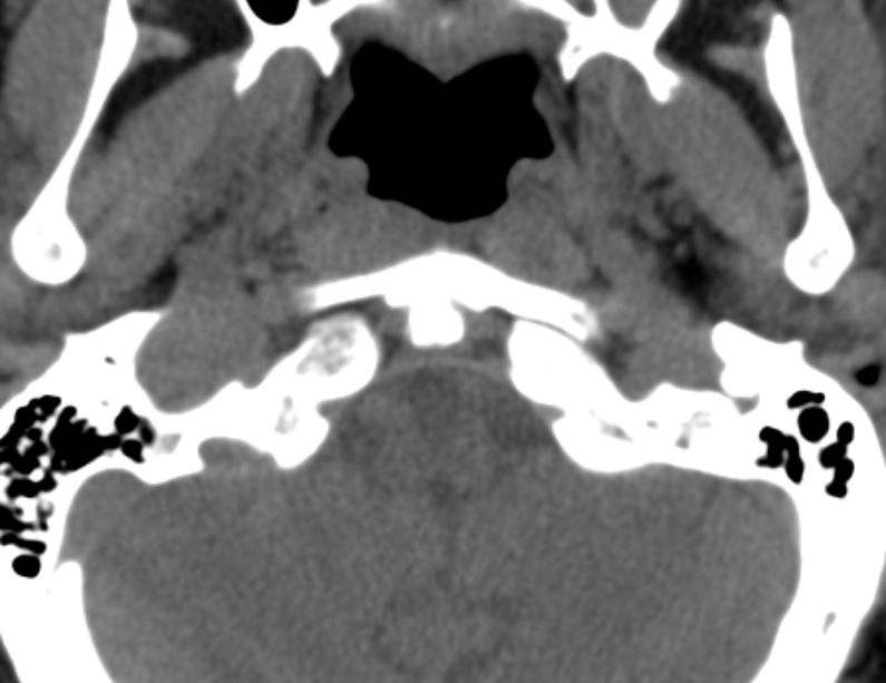 Anterior cervical postdiscectomy arthrodesis (Radiopaedia 32678-33646 Axial non-contrast 6).jpg