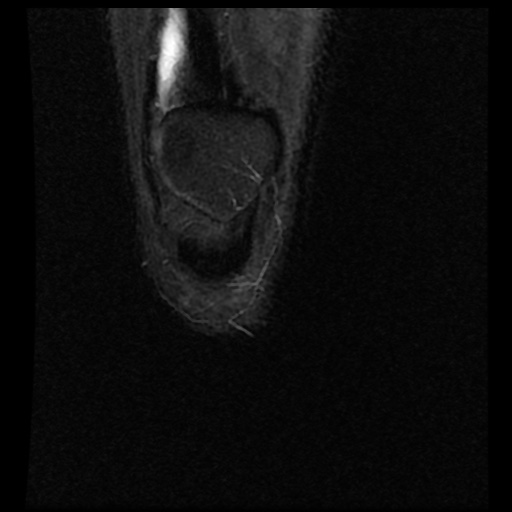 File:Anterior cruciate ligament avulsion fracture (Radiopaedia 58939-66193 Coronal STIR 2).jpg