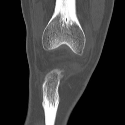 File:Anterior cruciate ligament avulsion fracture (Radiopaedia 58939-66194 Coronal bone window 3).jpg