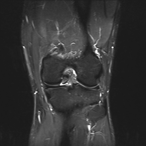 File:Anterior cruciate ligament full thickness tear (Radiopaedia 66268-75467 Coronal STIR 13).jpg