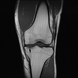 File:Anterior cruciate ligament full thickness tear (Radiopaedia 66268-75467 Coronal T1 9).jpg