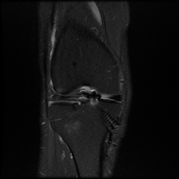 File:Anterior cruciate ligament graft tear and bucket-handle tear of medial meniscus (Radiopaedia 75867-87254 Coronal PD fat sat 9).jpg
