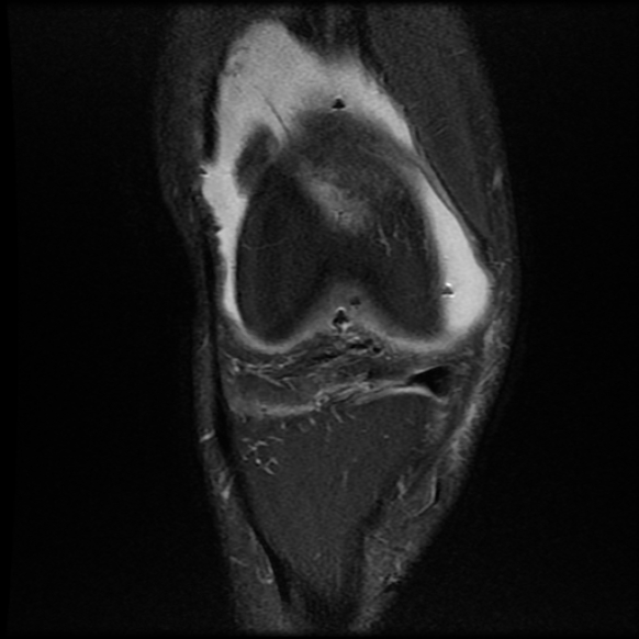 File:Anterior cruciate ligament graft tear and bucket-handle tear of medial meniscus (Radiopaedia 75867-87255 Coronal PD fat sat 8).jpg