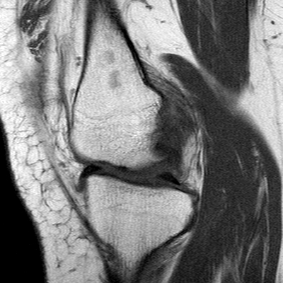 File:Anterior cruciate ligament mucoid degeneration (Radiopaedia 60853-68633 Sagittal T1 41).jpg