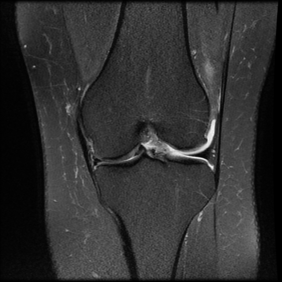 File:Anterior cruciate ligament tear, Wrisberg rip and bucket-handle tear of medial meniscus (Radiopaedia 75872-87266 Coronal PD fat sat 14).jpg