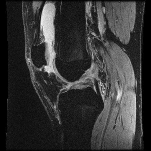 Anterior cruciate ligament tear (Radiopaedia 61500-69462 F 42).jpg