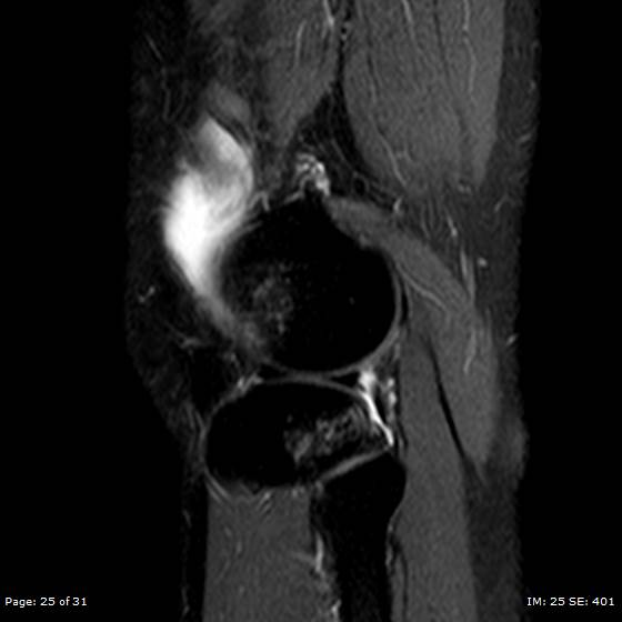 File:Anterior cruciate ligament tear (Radiopaedia 70783-80964 Sagittal STIR 25).jpg