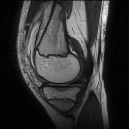 File:Anterior cruciate ligament tear - pediatric (Radiopaedia 62152-70260 Sagittal PD 55).jpg