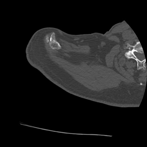 Anterior glenohumeral dislocation with Hill-Sachs lesion (Radiopaedia 62877-71249 Axial bone window 8).jpg
