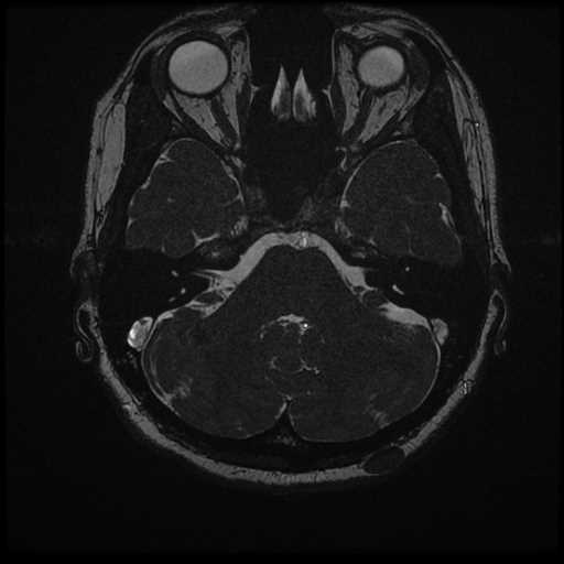 Anterior inferior cerebellar artery vascular loop - type II (Radiopaedia 70991-81209 Axial 3D FIESTA 32).jpg