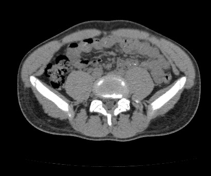 Anterior inferior iliac spine avulsion fracture (Radiopaedia 81312-94999 Axial non-contrast 16).jpg