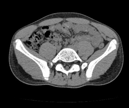 Anterior inferior iliac spine avulsion fracture (Radiopaedia 81312-94999 Axial non-contrast 21).jpg