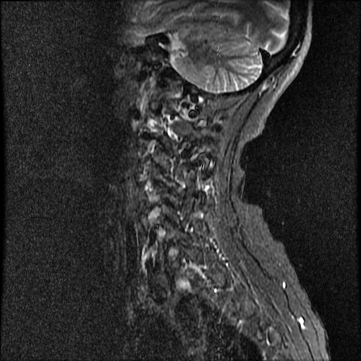 File:Anterior spinal artery syndrome (Radiopaedia 46335-50750 Sagittal STIR 11).png