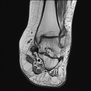 File:Anterior talofibular ligament injury - rupture with soft-tissue impingement (Radiopaedia 38765-40928 Coronal PD 18).jpg