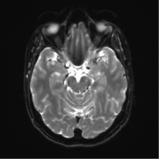 Anterior temporal lobe perivascular space (Radiopaedia 40946-43650 Axial DWI 10).png
