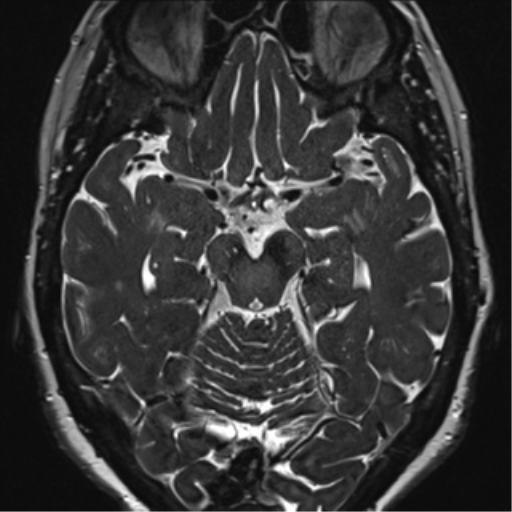 Anterior temporal pole cysts (Radiopaedia 46629-51102 Axial 48).png