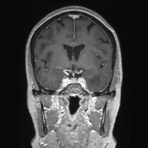 Anterior temporal pole cysts (Radiopaedia 46629-51102 Coronal T1 C+ 102).png