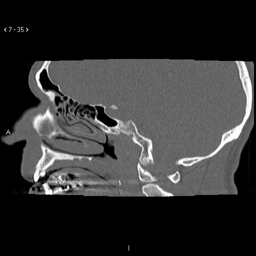 File:Antrochoanal Polyp (Radiopaedia 70510-80631 Sagittal bone window 25).jpg