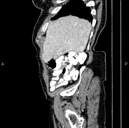 File:Aortic aneurysm and Lemmel syndrome (Radiopaedia 86499-102554 D 11).jpg