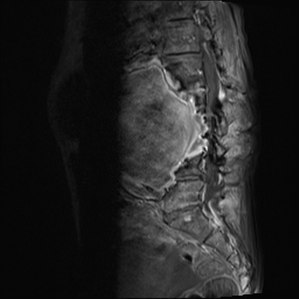 File:Aortic aneurysm with spinal destruction (Radiopaedia 42301-45409 Sagittal T1 fat sat 26).jpg