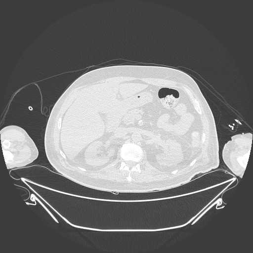 Aortic arch aneurysm (Radiopaedia 84109-99365 Axial lung window 311).jpg