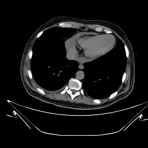 Aortic arch aneurysm (Radiopaedia 84109-99365 Axial non-contrast 210).jpg