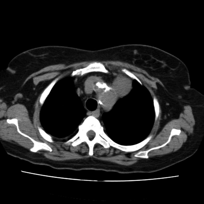 Aortic arch pseudoaneurysm (Radiopaedia 8534-9368 Axial non-contrast 14).jpg