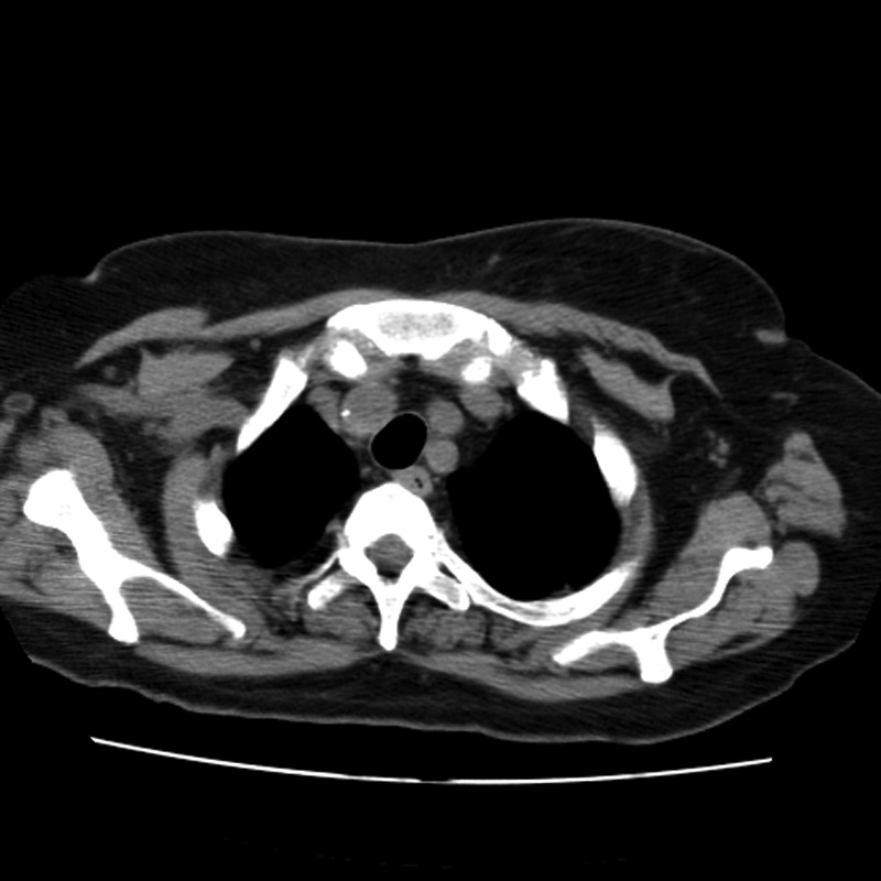 Aortic arch pseudoaneurysm (Radiopaedia 8534-9368 Axial non-contrast 7).jpg