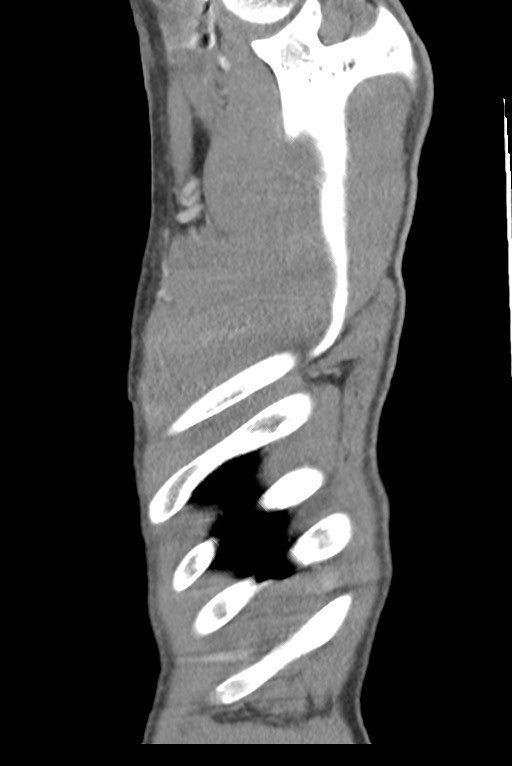 Aortic coarctation with aneurysm (Radiopaedia 74818-85828 B 148).jpg
