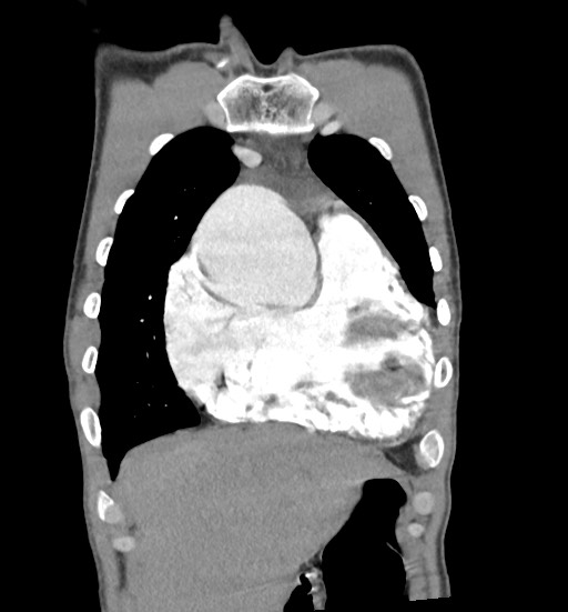 Aortic coarctation with aneurysm (Radiopaedia 74818-85828 C 25).jpg
