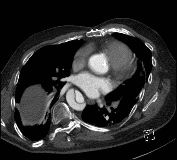 File:Aortic dissection (CTPA) (Radiopaedia 75506-86750 A 53).jpg