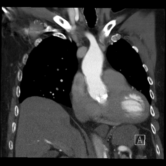 File:Aortic dissection (CTPA) (Radiopaedia 75506-86750 B 26).jpg